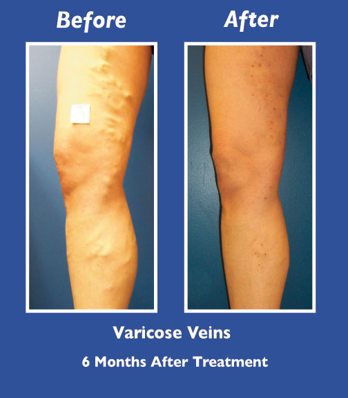 Before and After Leg Vein Treatment by Dr. Normand Miller, Salem, NH and Nashua, NH