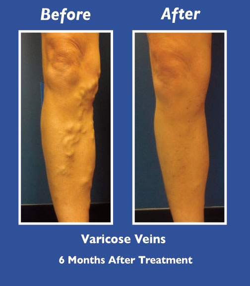 Before and After Leg Vein Treatment by Dr. Normand Miller, Salem, NH and Nashua, NH