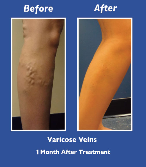 Before and After Leg Vein Treatment by Dr. Normand Miller, Salem, NH and Nashua, NH