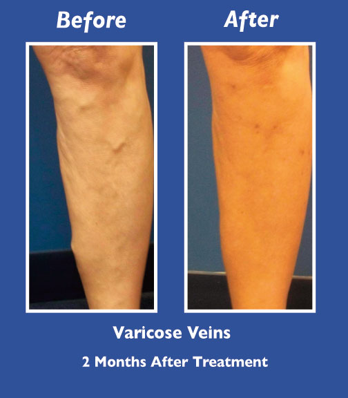 Before and After Leg Vein Treatment by Dr. Normand Miller, Salem, NH and Nashua, NH