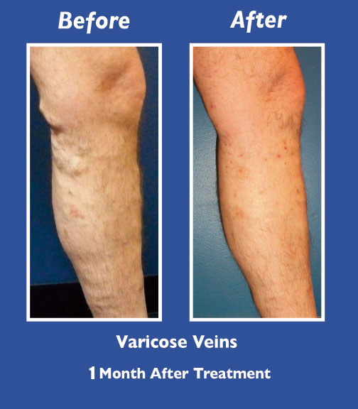 Before and After Leg Vein Treatment by Dr. Normand Miller, Salem, NH and Nashua, NH