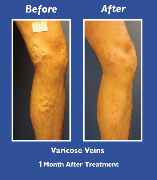 Before and After Leg Vein Treatment by Dr. Normand Miller, Salem, NH and Nashua, NH