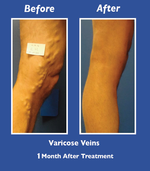 Before and After Leg Vein Treatment by Dr. Normand Miller, Salem, NH and Nashua, NH