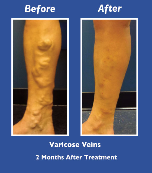 Before and After Leg Vein Treatment by Dr. Normand Miller, Salem, NH and Nashua, NH