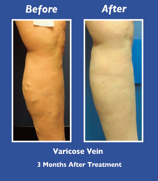 Before and After Leg Vein Treatment by Dr. Normand Miller, Salem, NH and Nashua, NH