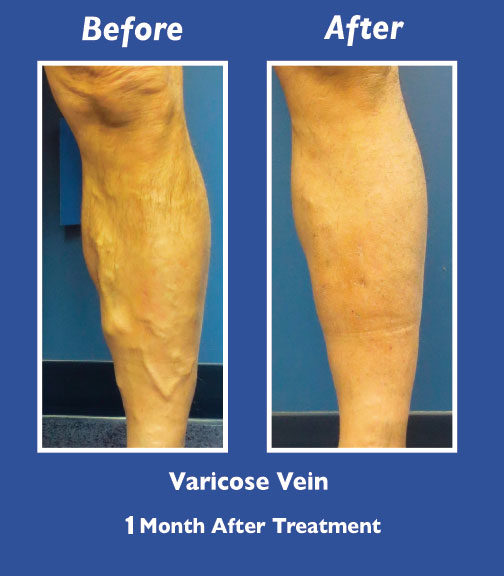 Before and After Leg Vein Treatment by Dr. Normand Miller, Salem, NH and Nashua, NH