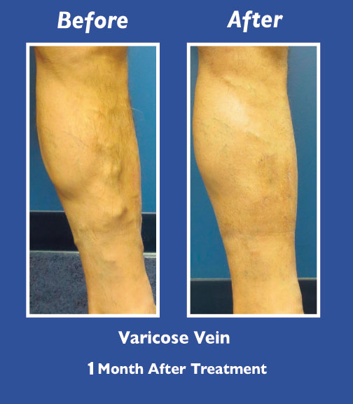 Before and After Leg Vein Treatment by Dr. Normand Miller, Salem, NH and Nashua, NH