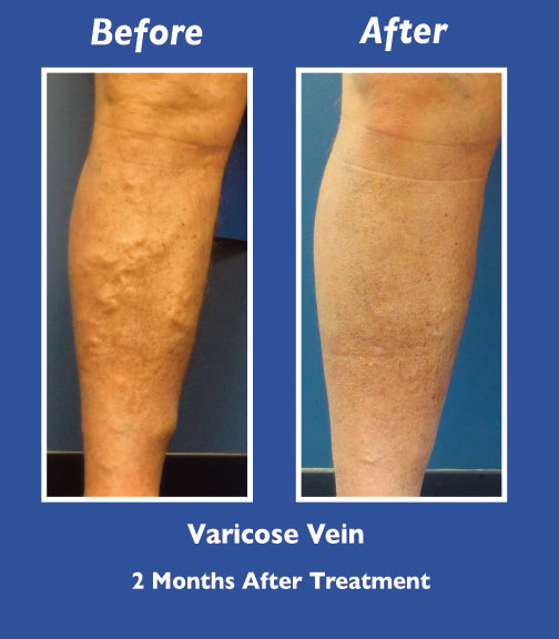 Before and After Leg Vein Treatment by Dr. Normand Miller, Salem, NH and Nashua, NH