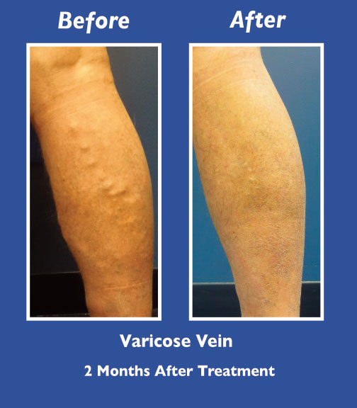 Before and After Leg Vein Treatment by Dr. Normand Miller, Salem, NH and Nashua, NH