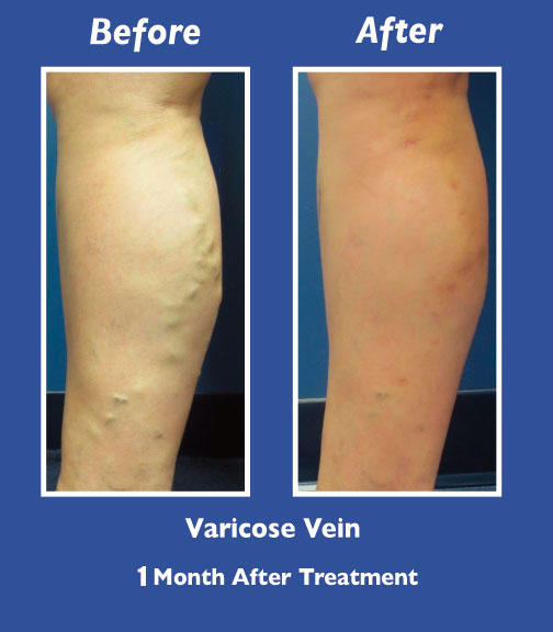 Before and After Leg Vein Treatment by Dr. Normand Miller, Salem, NH and Nashua, NH