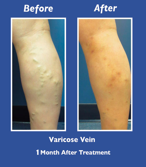 Before and After Leg Vein Treatment by Dr. Normand Miller, Salem, NH and Nashua, NH