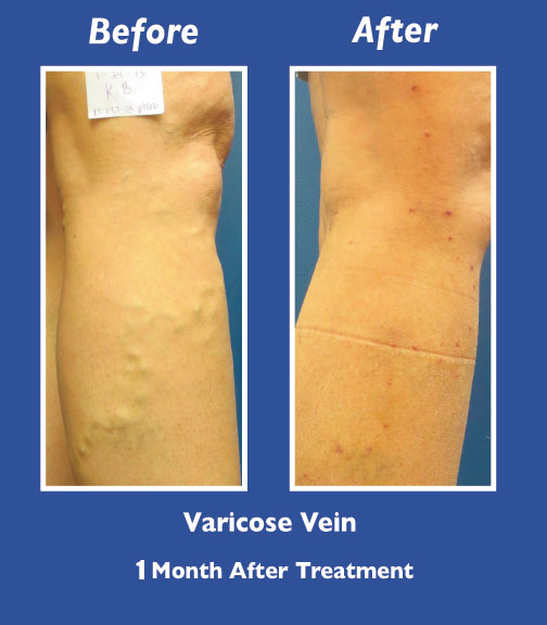 Before and After Leg Vein Treatment by Dr. Normand Miller, Salem, NH and Nashua, NH