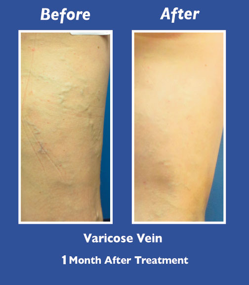 Before and After Leg Vein Treatment by Dr. Normand Miller, Salem, NH and Nashua, NH