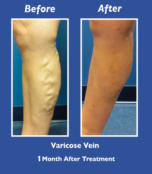 Before and After Leg Vein Treatment by Dr. Normand Miller, Salem, NH and Nashua, NH