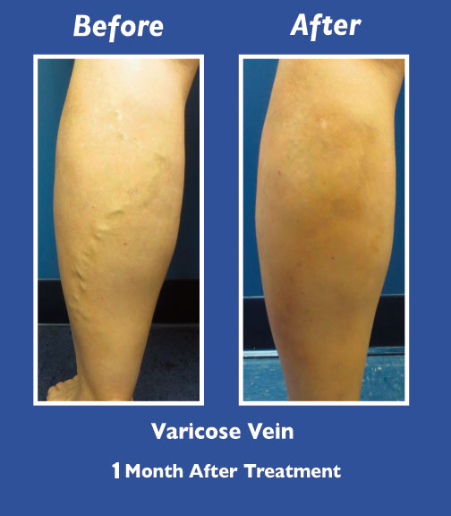 Before and After Leg Vein Treatment by Dr. Normand Miller, Salem, NH and Nashua, NH