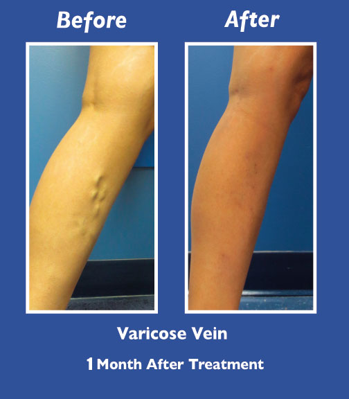 Before and After Leg Vein Treatment by Dr. Normand Miller, Salem, NH and Nashua, NH