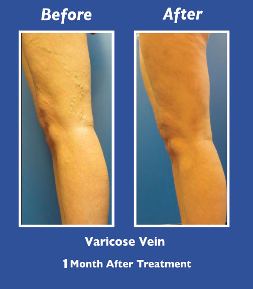 Before and After Leg Vein Treatment by Dr. Normand Miller, Salem, NH and Nashua, NH