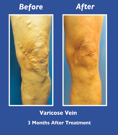 Before and After Leg Vein Treatment by Dr. Normand Miller, Salem, NH and Nashua, NH