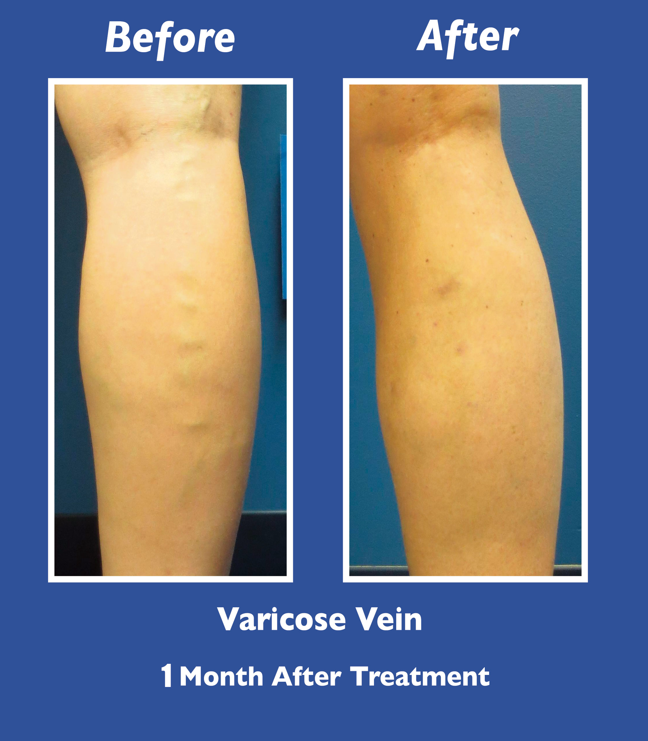 Before and After Leg Vein Treatment by Dr. Normand Miller, Salem, NH and Nashua, NH