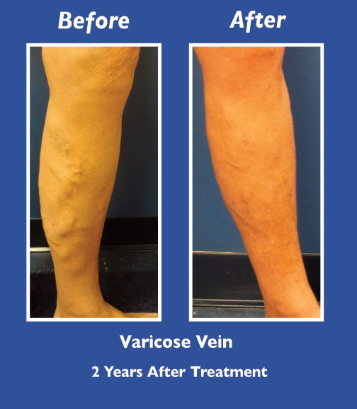 Before and After Leg Vein Treatment by Dr. Normand Miller, Salem, NH and Nashua, NH