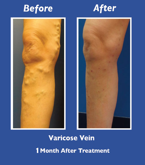 Before and After Leg Vein Treatment by Dr. Normand Miller, Salem, NH and Nashua, NH