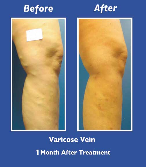 Before and After Leg Vein Treatment by Dr. Normand Miller, Salem, NH and Nashua, NH