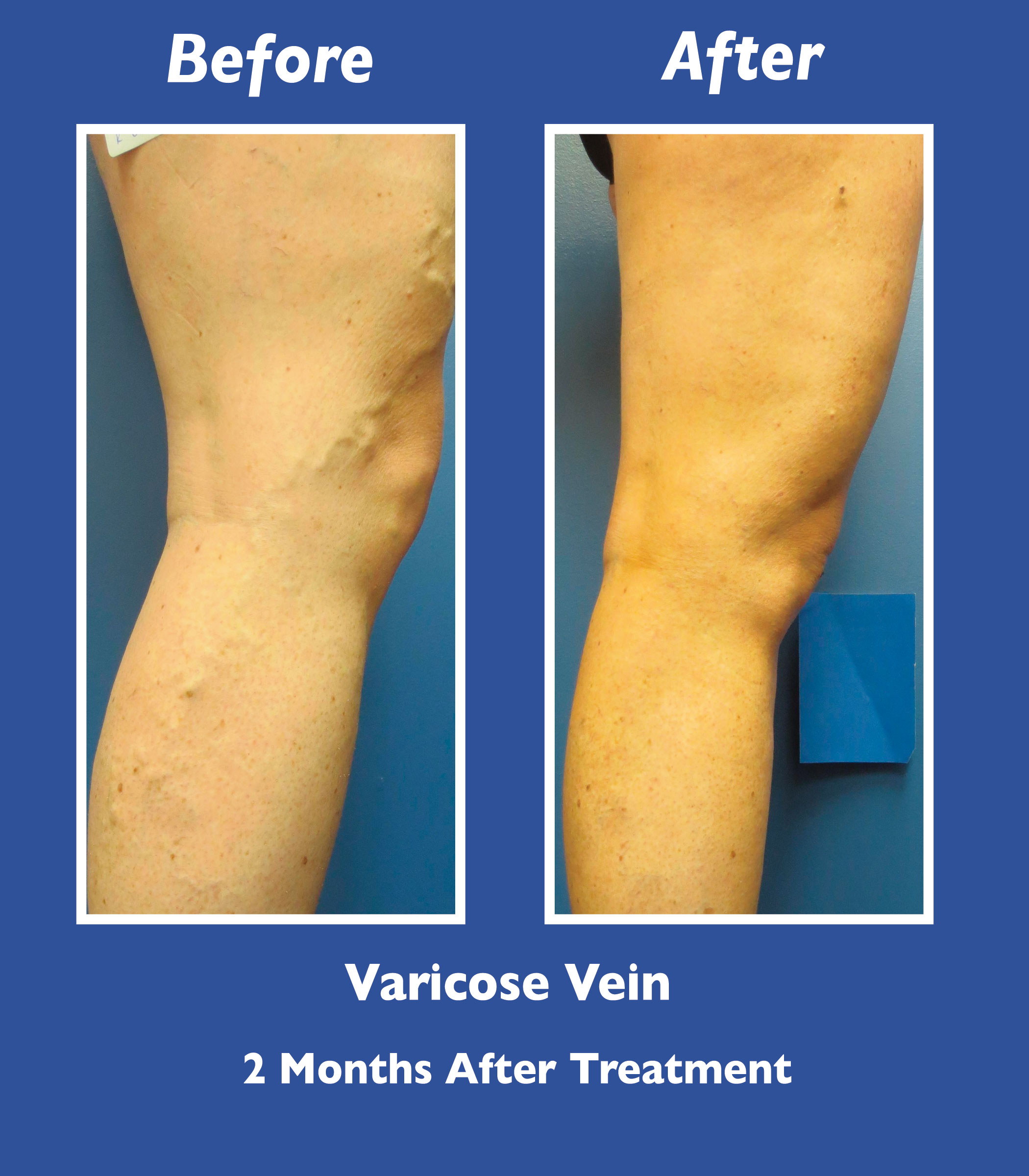 Before and After Leg Vein Treatment by Dr. Normand Miller, Salem, NH and Nashua, NH