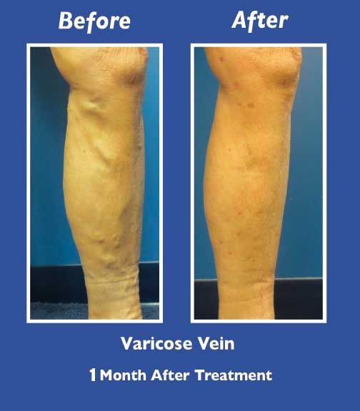 Before and After Leg Vein Treatment by Dr. Normand Miller, Salem, NH and Nashua, NH