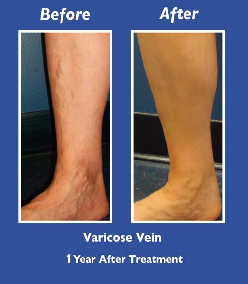 Before and After Leg Vein Treatment by Dr. Normand Miller, Salem, NH and Nashua, NH