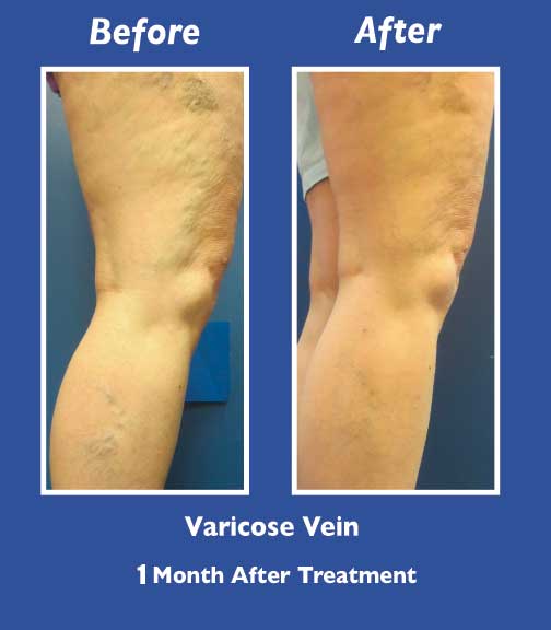 Before and After Leg Vein Treatment by Dr. Normand Miller, Salem, NH and Nashua, NH