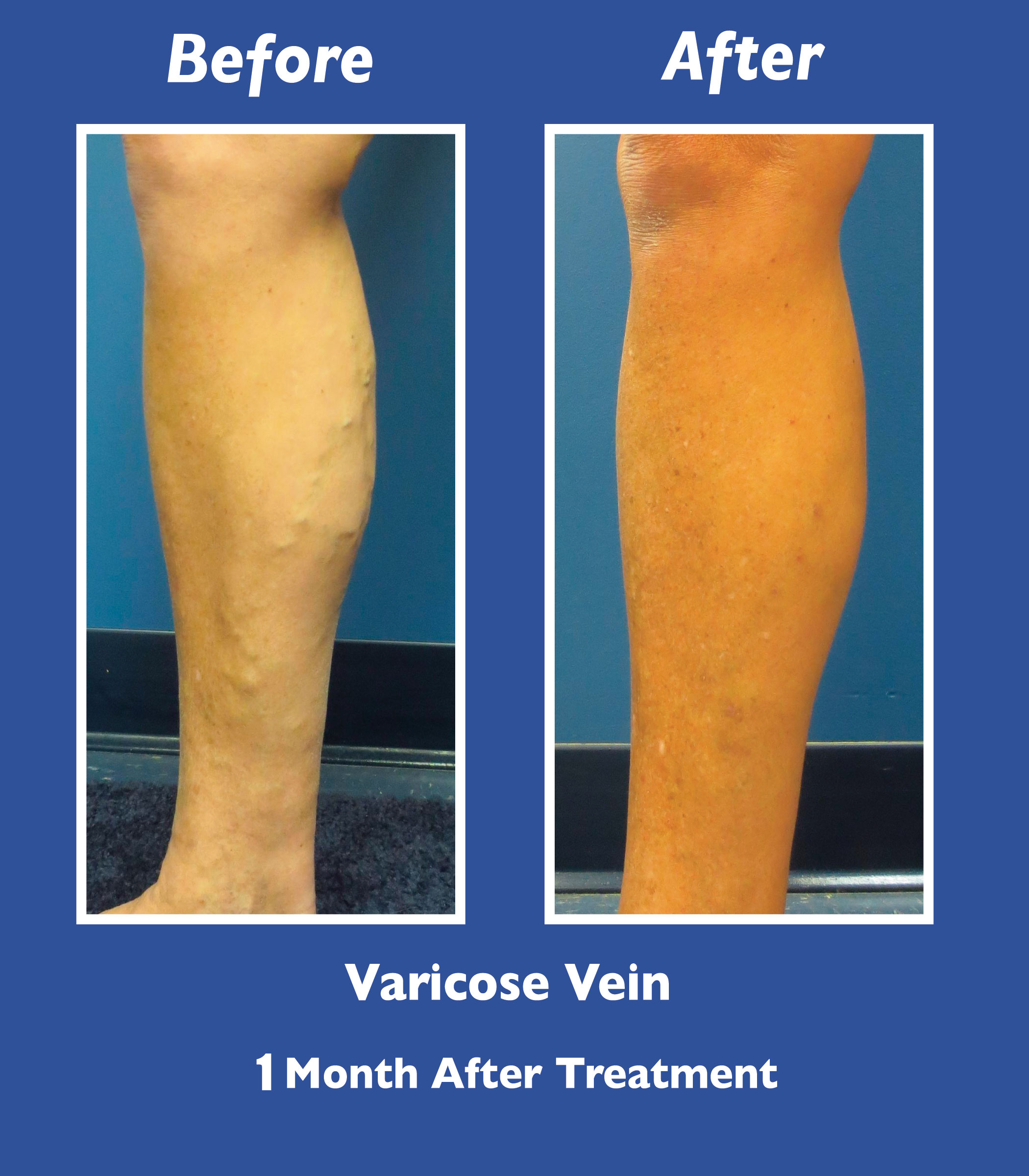 Before and After Leg Vein Treatment by Dr. Normand Miller, Salem, NH and Nashua, NH