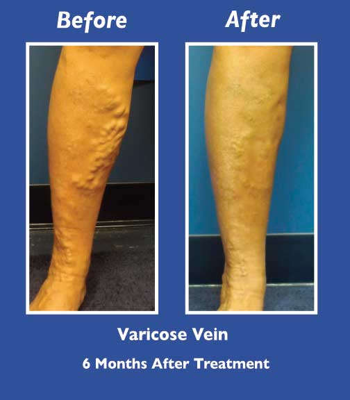 Before and After Leg Vein Treatment by Dr. Normand Miller, Salem, NH and Nashua, NH