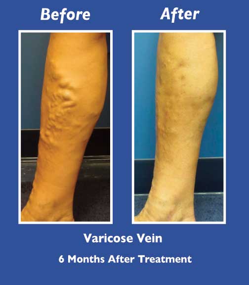 Before and After Leg Vein Treatment by Dr. Normand Miller, Salem, NH and Nashua, NH