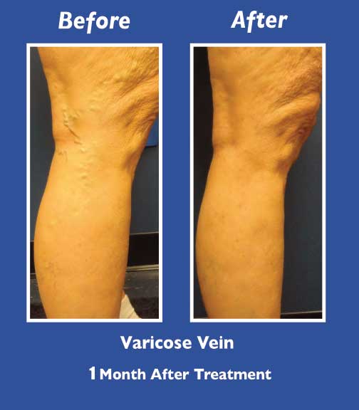 Before and After Leg Vein Treatment by Dr. Normand Miller, Salem, NH and Nashua, NH