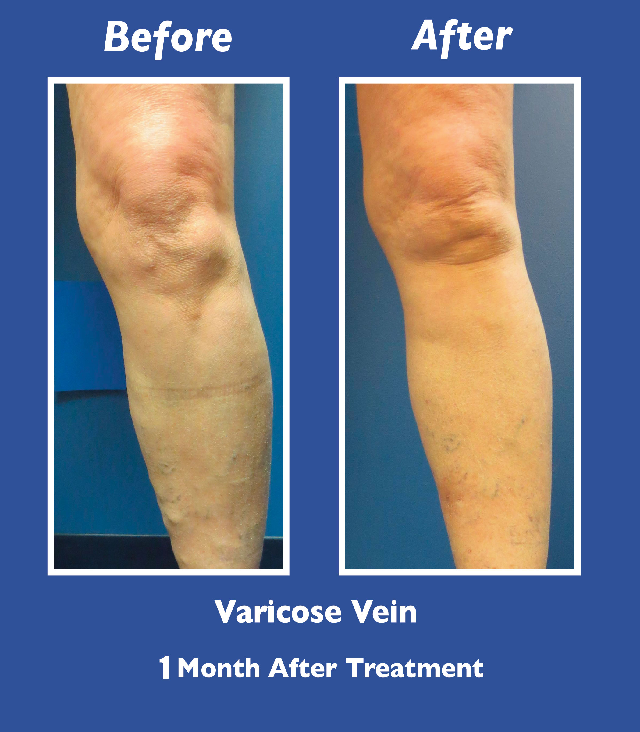 Before and After Leg Vein Treatment by Dr. Normand Miller, Salem, NH and Nashua, NH