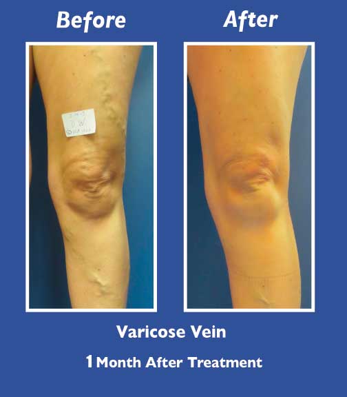 Before and After Leg Vein Treatment by Dr. Normand Miller, Salem, NH and Nashua, NH