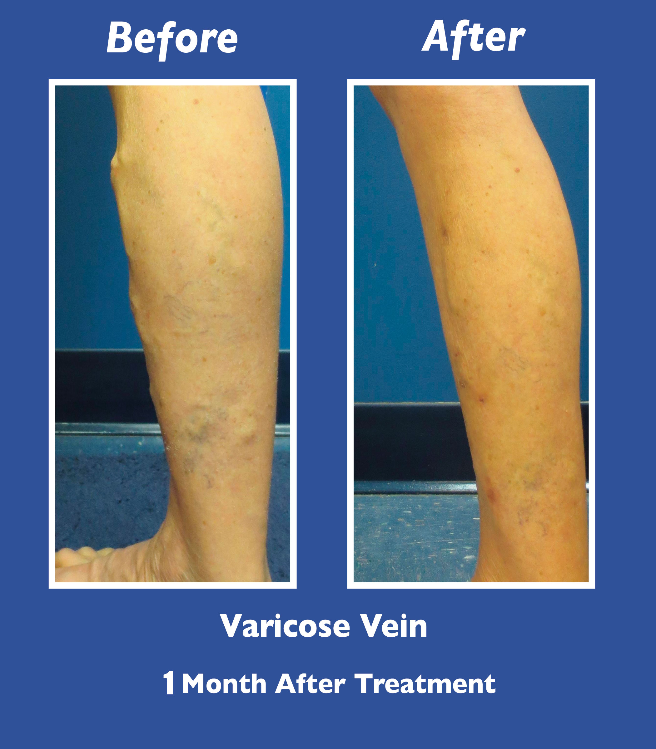 Before and After Leg Vein Treatment by Dr. Normand Miller, Salem, NH and Nashua, NH