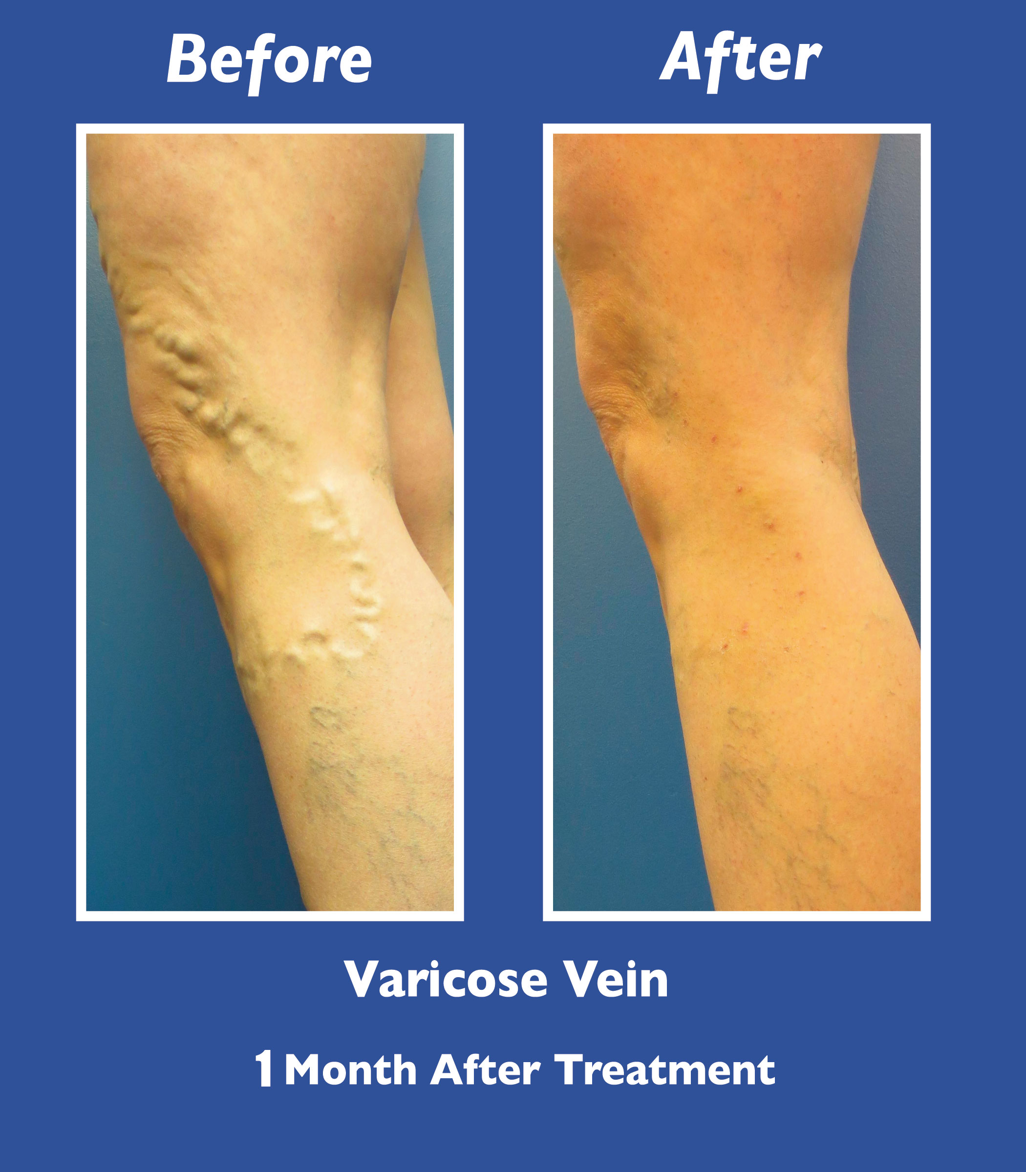 Before and After Leg Vein Treatment by Dr. Normand Miller, Salem, NH and Nashua, NH