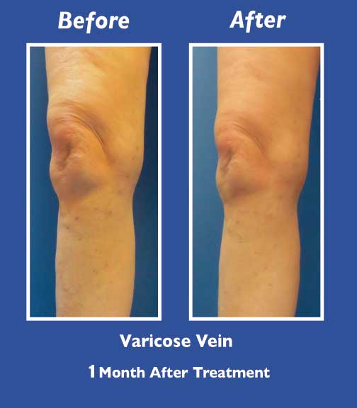 Before and After Leg Vein Treatment by Dr. Normand Miller, Salem, NH and Nashua, NH