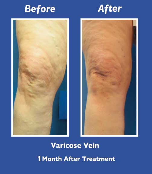 Before and After Leg Vein Treatment by Dr. Normand Miller, Salem, NH and Nashua, NH