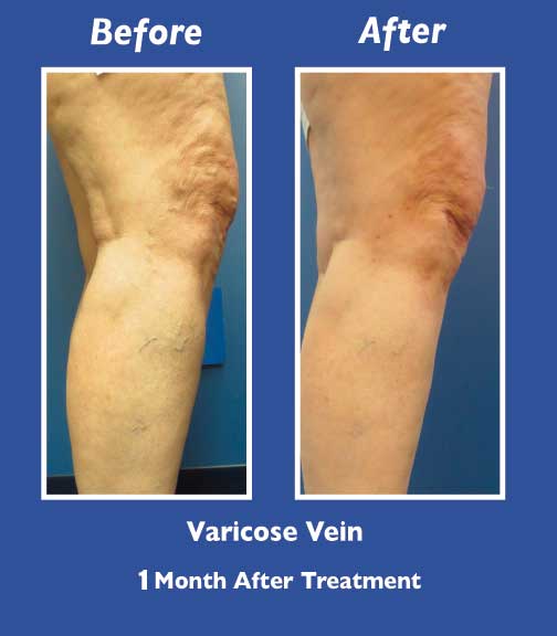 Before and After Leg Vein Treatment by Dr. Normand Miller, Salem, NH and Nashua, NH