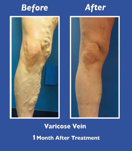 Before and After Leg Vein Treatment by Dr. Normand Miller, Salem, NH and Nashua, NH