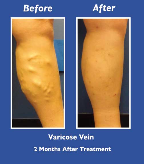 Before and After Leg Vein Treatment by Dr. Normand Miller, Salem, NH and Nashua, NH