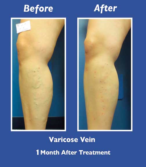 Before and After Leg Vein Treatment by Dr. Normand Miller, Salem, NH and Nashua, NH