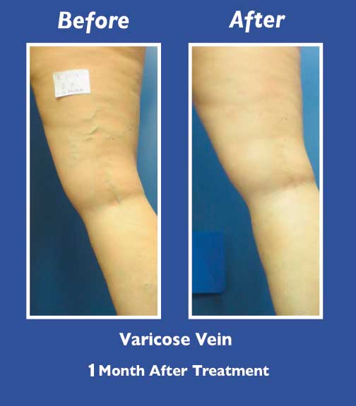 Before and After Leg Vein Treatment by Dr. Normand Miller, Salem, NH and Nashua, NH