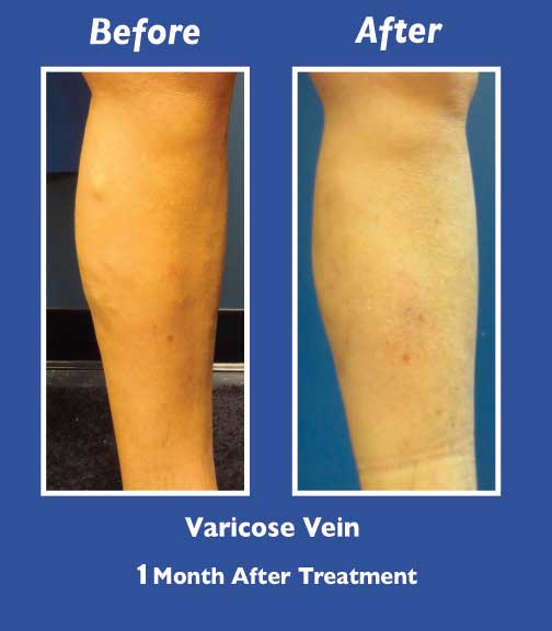 Before and After Leg Vein Treatment by Dr. Normand Miller, Salem, NH and Nashua, NH