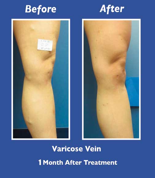 Before and After Leg Vein Treatment by Dr. Normand Miller, Salem, NH and Nashua, NH