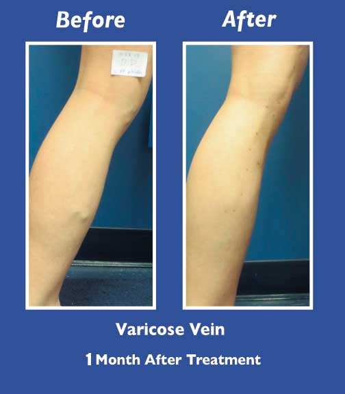 Before and After Leg Vein Treatment by Dr. Normand Miller, Salem, NH and Nashua, NH