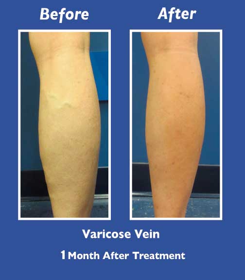 Before and After Leg Vein Treatment by Dr. Normand Miller, Salem, NH and Nashua, NH