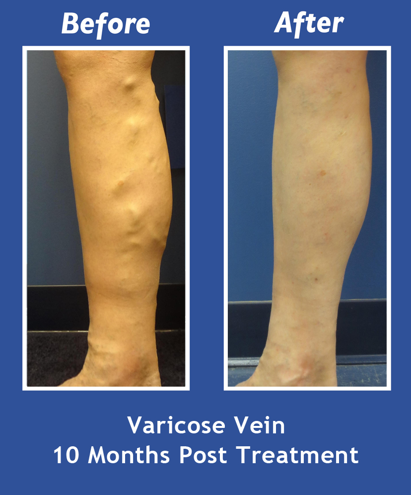 Before and After Leg Vein Treatment by Dr. Normand Miller, Salem, NH and Nashua, NH